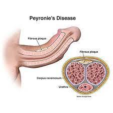 peyronie's disease picture